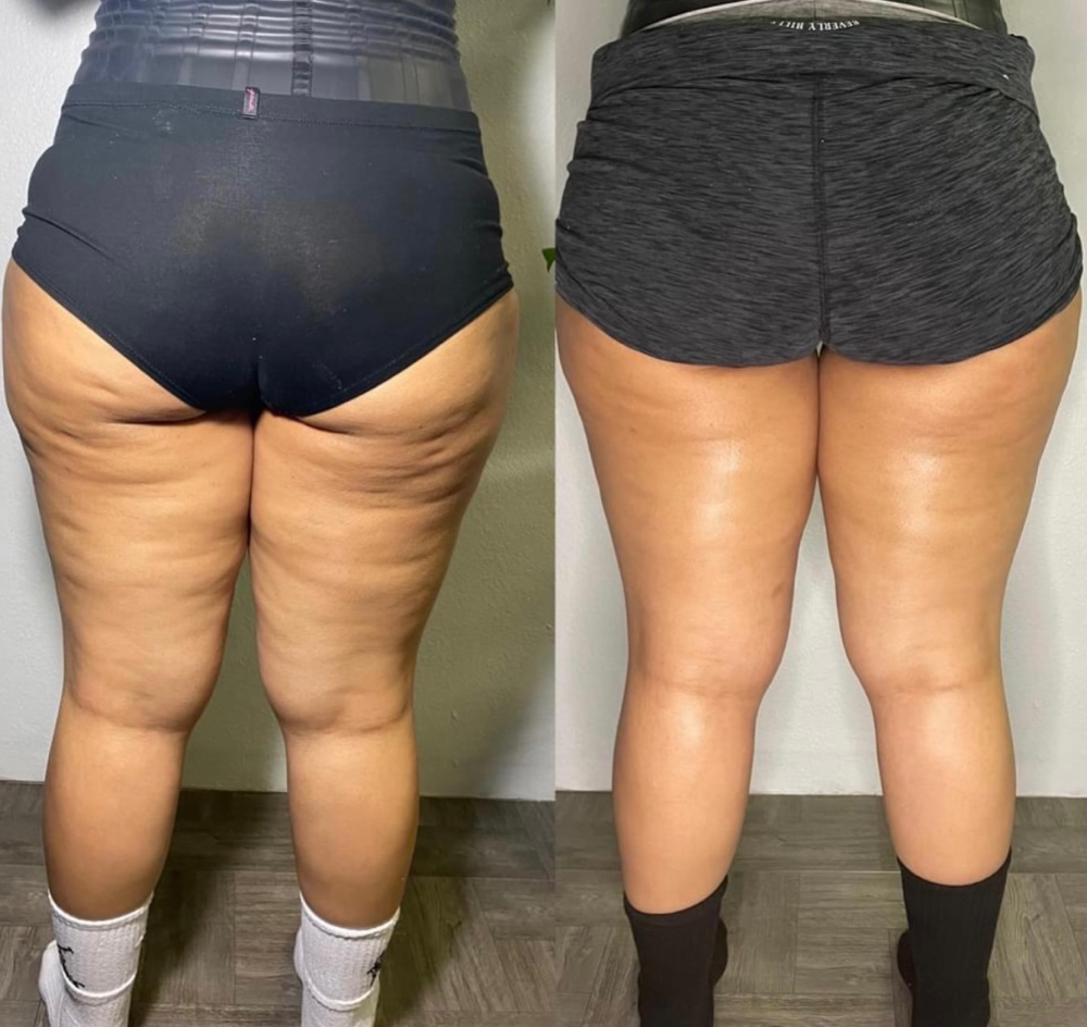 Cellulite Leg Treatment treatment at SnatchedLV