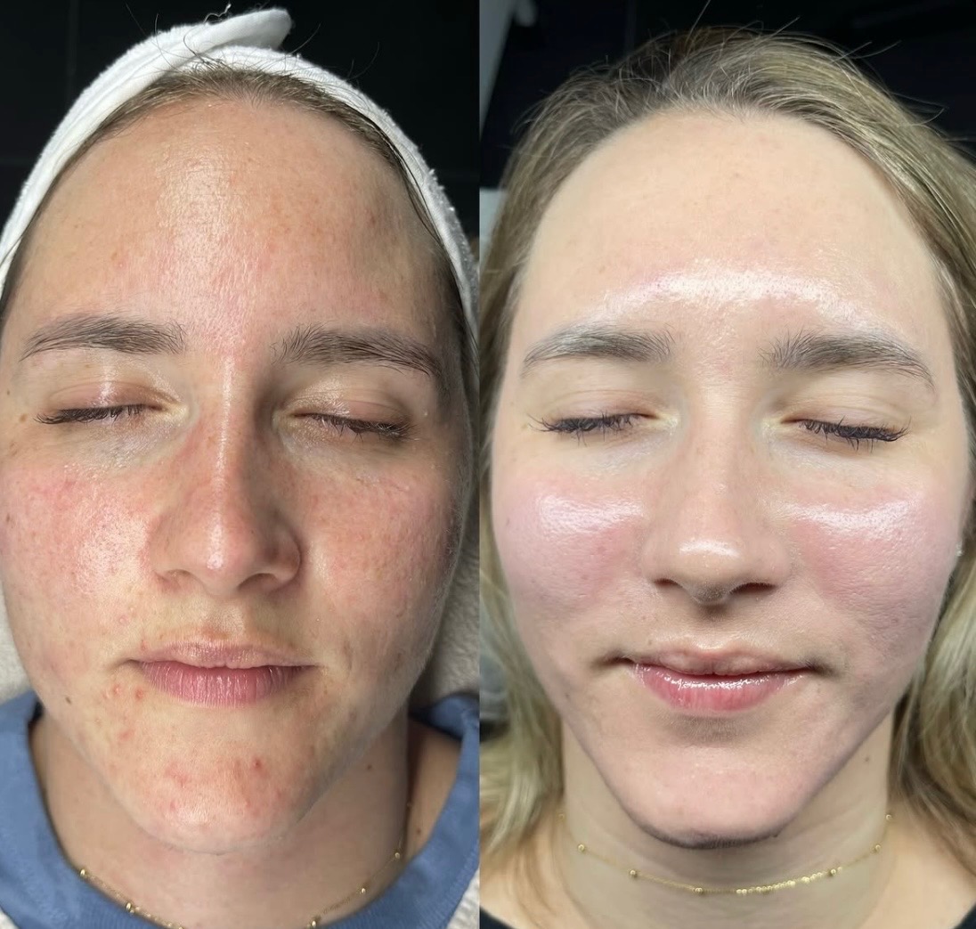Chemical Peel treatment at SnatchedLV