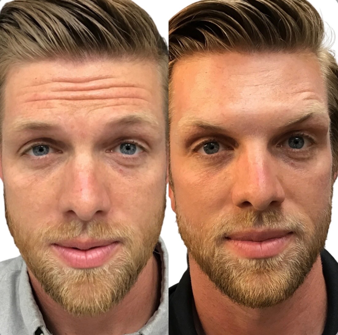 Gentlemen's Botox Facial treatment at SnatchedLV