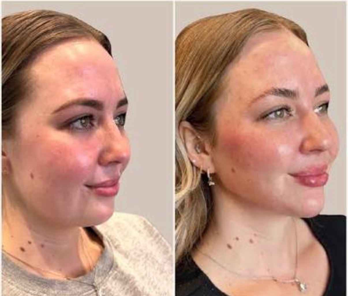 Lymphatic Sculpting Facial – Lift & Glow treatment at SnatchedLV