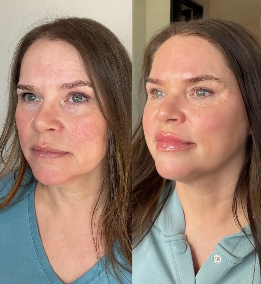 Microchanneling treatment at SnatchedLV