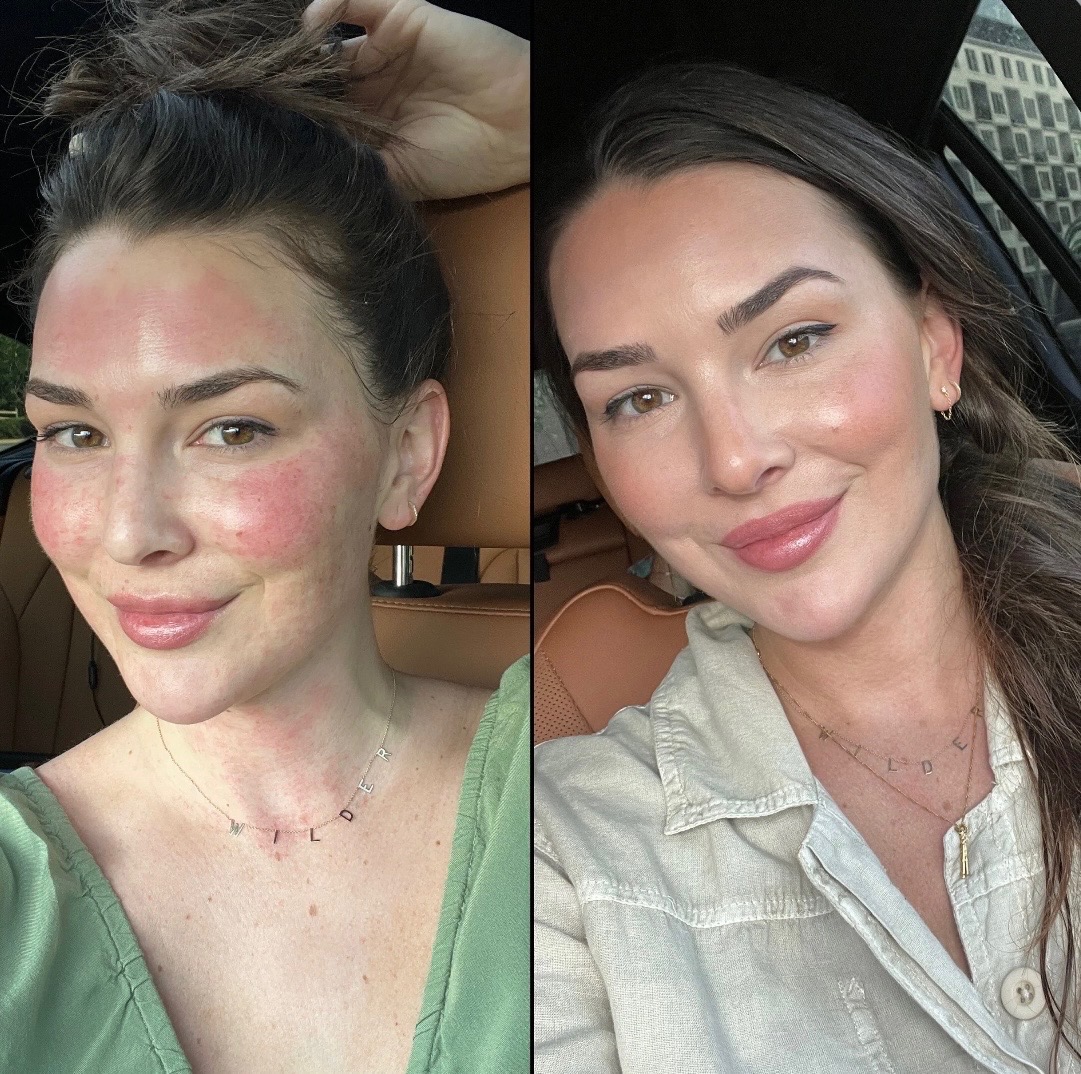 Microneedling treatment at SnatchedLV