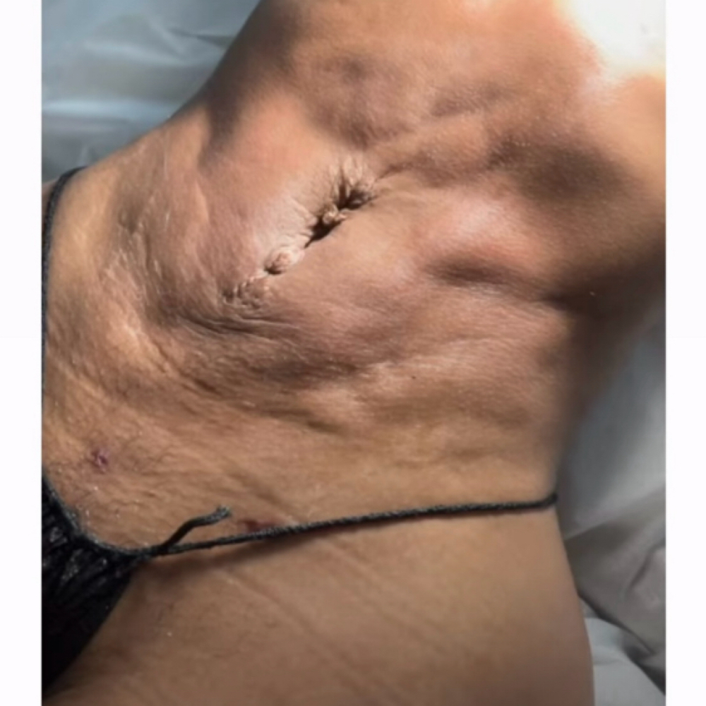 Fibrosis Treatment treatment at SnatchedLV