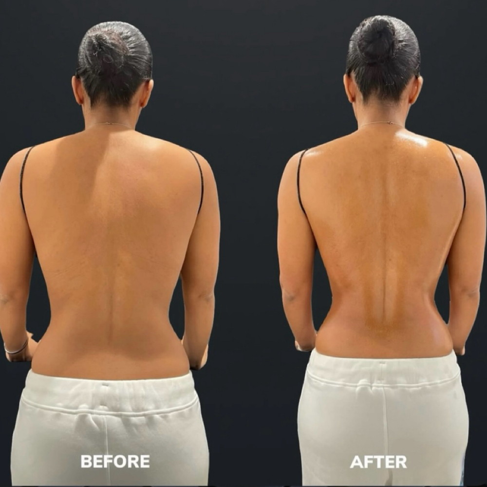 Post Operative Care treatment at SnatchedLV