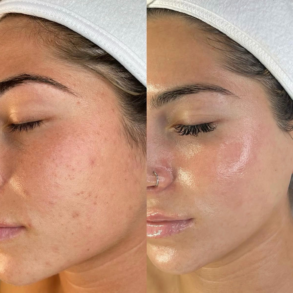 Virtual Face Consultation treatment at SnatchedLV